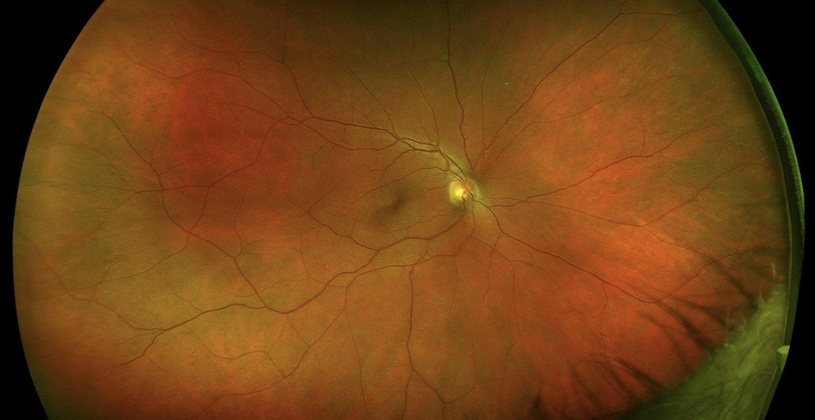 Retina